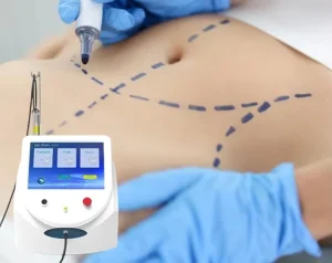 Professional Portable 980nm Diode Laser Beauty Equipment for Vascular Lesion Removal & Onychomycosis Therapy Machine
